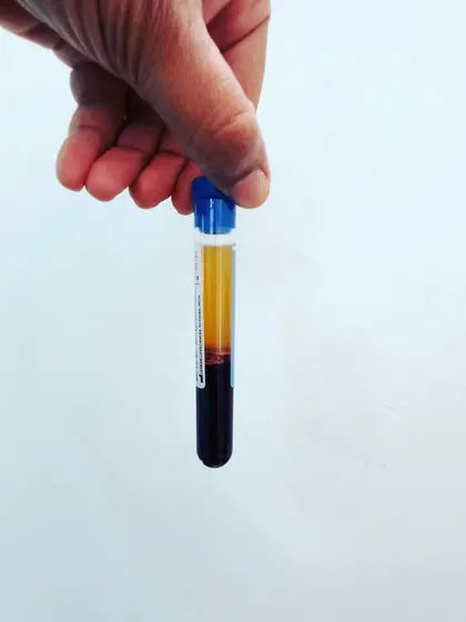 Holding a prepared vial of PRP. This simple blood draw is the first step in a powerful, natural treatment for skin rejuvenation and scar repair.