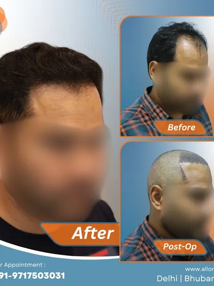 This series shows the complete process for a patient, from the before and post-op stages to the final impressive result. It gives a comprehensive view of the transformation journey.