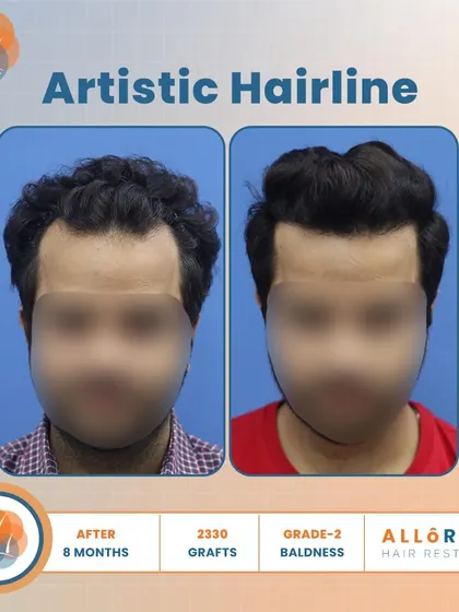 An artistic hairline is key to a natural result. This 8-month result for Grade 2 baldness, using 2330 grafts, shows how I meticulously design the hairline to be soft and irregular, avoiding a fake, pluggy look.