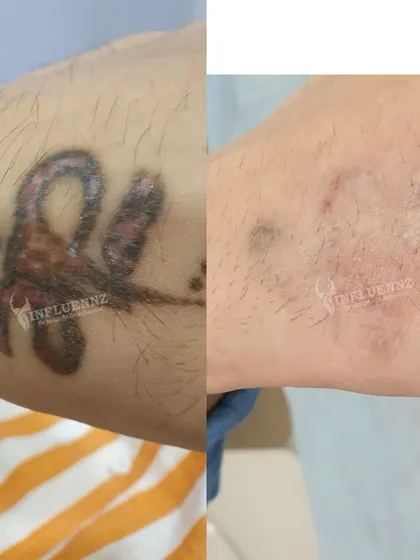 A multi colored tattoo on the arm showing significant fading. The process is gradual, but with consistent sessions, we can effectively remove even complex tattoos.