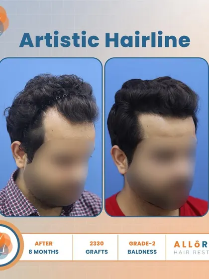 An artistic hairline is key to a natural result. This 8-month result for Grade 2 baldness, using 2330 grafts, shows how I meticulously design the hairline to be soft and irregular, avoiding a fake, pluggy look.