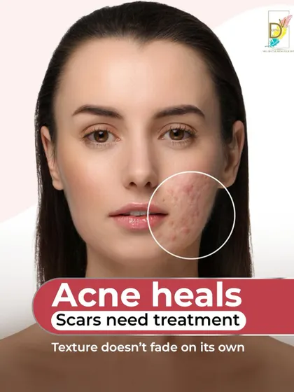 Many people believe acne marks will fade on their own, but this is a myth. While a pimple heals, the scar it leaves behind is a permanent change in skin texture that requires professional treatment. My approach is to assess the scar depth and your skin's healing capacity to create a strategy for real, lasting smoothness.