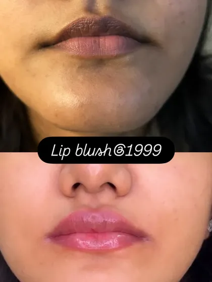 A subtle yet impactful lip blush result. This before and after shows how the treatment can even out skin tone and add a soft, healthy color for a 'your lips but better' look.