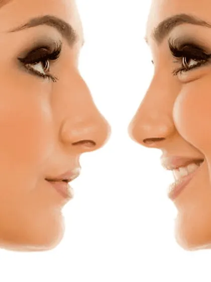 A side-profile comparison illustrating the kind of change that is possible with rhinoplasty. The focus is on creating a balanced and proportionate nasal structure.