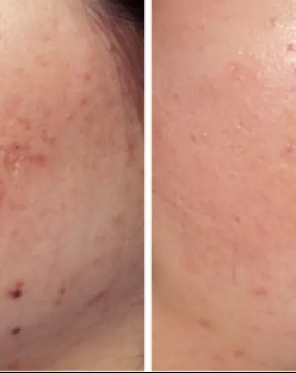 Notice the significant improvement in both post-inflammatory hyperpigmentation (dark spots) and textural scarring. This was achieved with a combination of treatments designed to first calm the inflammation and then remodel the skin's surface.