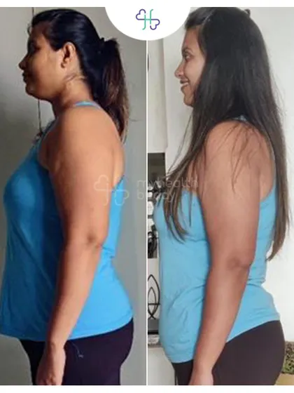 The side profile of Ishani's transformation. My consistent follow-ups and guidance helped her stay motivated even when her energy was low.
