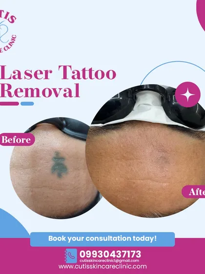 This is a clear example of a successful laser tattoo removal. Using advanced Q-switch laser technology, we were able to significantly fade this tattoo over several sessions, leaving the skin clear and demonstrating the effectiveness of our scar-minimized approach.