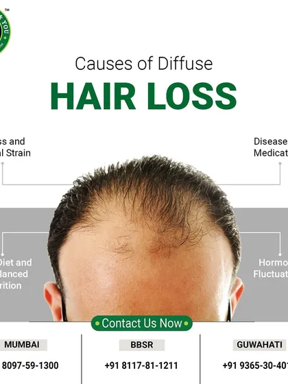 This graphic explains the common causes of diffuse hair loss, including stress, poor diet, hormonal fluctuations, and certain medications. Understanding the cause is the first step toward finding the right solution.