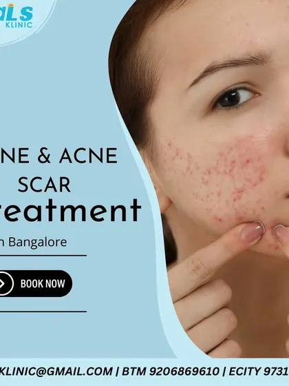 This shows a typical case of acne and post-inflammatory scarring that I treat at my clinic. My goal is to provide effective, customized acne and scar removal plans for patients in Bangalore.