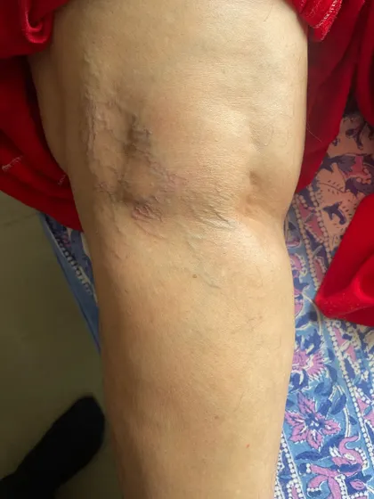 Another angle of the final result, showing smoother skin and healthier-looking circulation. Our treatments help restore confidence and comfort for our clients.