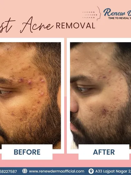 Cystic acne requires a professional approach. This before-and-after shows a significant reduction in inflammation and breakouts after a targeted treatment plan.