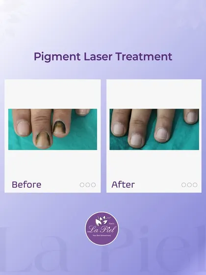 Pigmentation can also affect the nails, causing discoloration that can be concerning. This before-and-after shows the successful outcome of our pigment laser treatment on a nail, restoring its natural and healthy appearance.