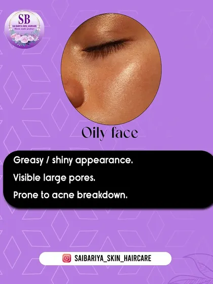 This graphic explains the characteristics of an oily face: a greasy or shiny appearance, visible large pores, and being prone to acne. If this is you, I have solutions for you.