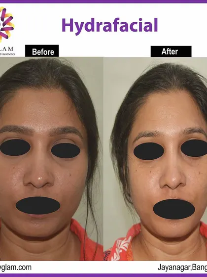 A clear example of the immediate results from a single Hydrafacial session. The client's skin appears visibly brighter, more hydrated, and smoother, demonstrating the effectiveness of this treatment for instant rejuvenation and glow.