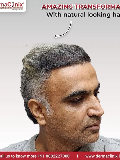 A side profile of Mr. Dhiraj's amazing transformation. This angle highlights the natural looking hairline and the density achieved, which is a hallmark of our surgical skill.