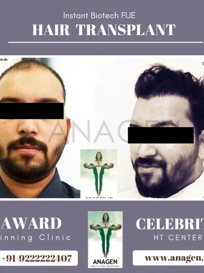 Another excellent result from our Instant Biotech FUE hair transplant. The patient's transformation is clear, with a fuller and more defined hairline.