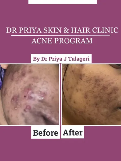 This before-and-after image showcases the tangible results of my structured acne program. The patient presented with severe cystic acne and post-inflammatory hyperpigmentation. Through a tailored combination of treatments, we achieved a significant reduction in active lesions and a visible clearing of marks.