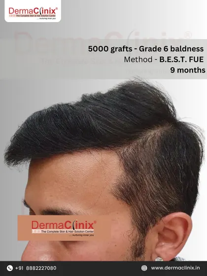 A side view of a 5000 graft B.E.S.T. FUE procedure after nine months for a patient with Grade 6 baldness. This angle highlights the natural flow and density of the transplanted hair.