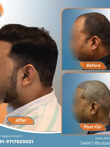 Another complete journey from before to post-op to a fantastic final result. This visual story demonstrates the effectiveness and predictability of my FUE hair transplant technique.