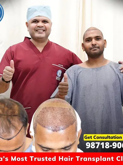This patient with Grade 5 baldness received 4649 grafts. The photos show the transformation from the initial consultation and hairline design to the immediate result after the FUE procedure.