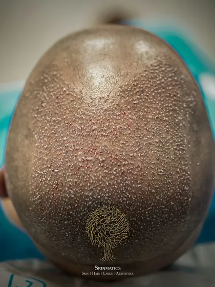 A top-down view of a completed hair transplant session. Thousands of grafts have been placed to restore coverage across the crown and mid-scalp area.