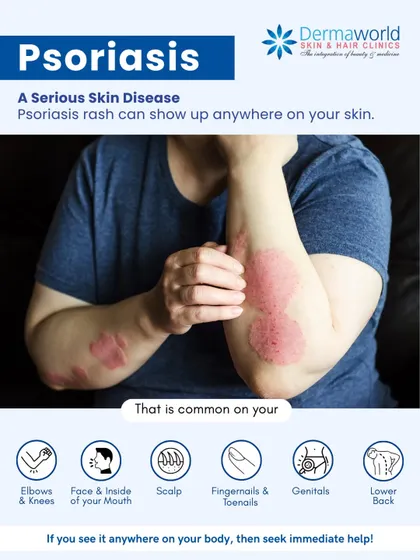 Psoriasis is more than just a rash; it's a serious skin disease that can appear on elbows, the scalp, and even nails. Understanding where it can show up is the first step toward seeking the immediate help needed to manage it effectively.
