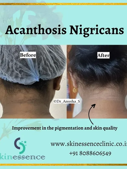 This patient was concerned about Acanthosis Nigricans, a common condition causing dark, thickened skin on the neck. Using a combination of treatments including laser sessions, we achieved a significant improvement in both the pigmentation and the overall skin texture.