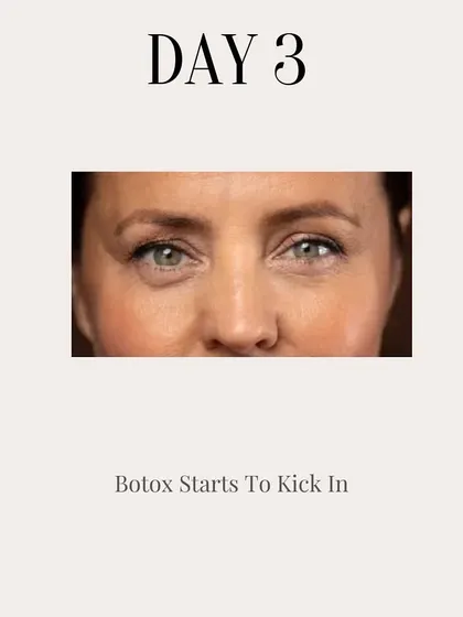 On day three after a Botox injection, the product begins to kick in. You'll start to notice a subtle softening of lines and a reduction in muscle movement in the treated area.