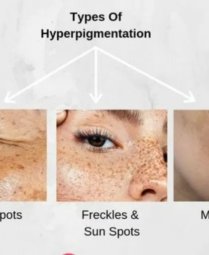 This infographic clearly shows the three most common types of hyperpigmentation I see in my clinic: age spots, freckles/sun spots, and melasma. Understanding which one you have is the first step toward getting the right treatment.