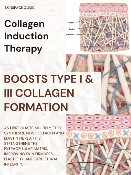 Known as Collagen Induction Therapy, microneedling boosts the formation of Type I and III collagen. As fibroblasts multiply, they create new collagen and elastin fibers, strengthening the skin's structure for improved firmness and elasticity.