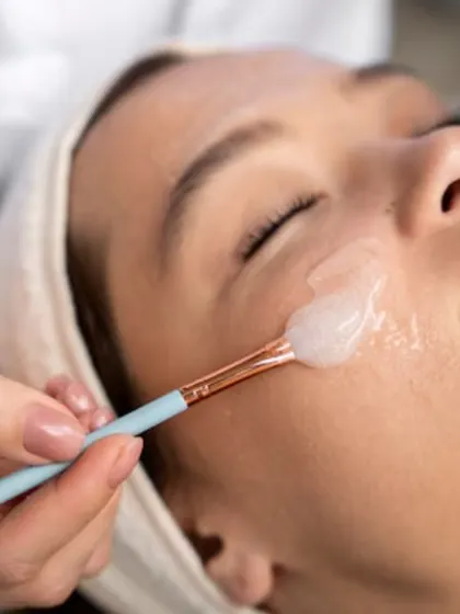 A chemical peel being applied by a professional. I use customized chemical peels to exfoliate the skin, reduce pigmentation, treat acne, and reveal smoother, brighter skin underneath.