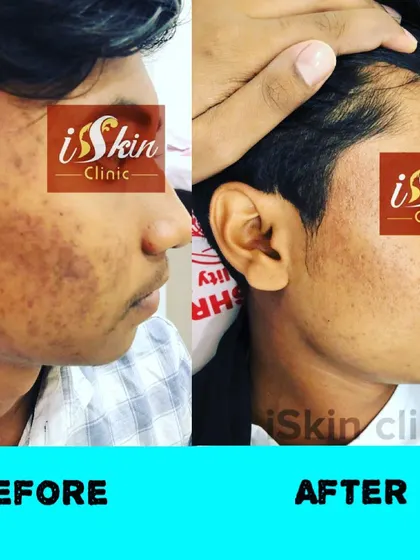 This image showcases a successful transformation for a patient undergoing acne and pigmentation treatment. The 'after' photo displays a dramatic reduction in active acne and post-inflammatory hyperpigmentation.