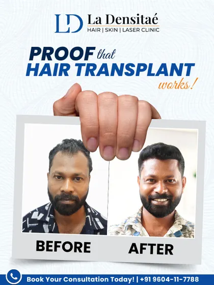Still wondering if hair transplants work? Biju did too, until he got 2,700 grafts and saw the change for himself. This is medically-backed proof that a real, long-term solution is available.