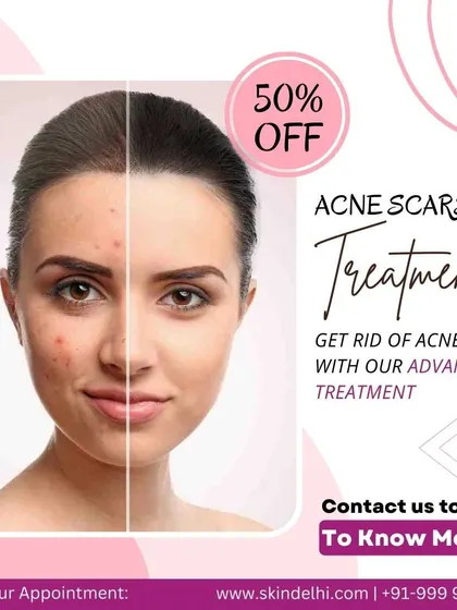 A before-and-after split-screen image advertising a 50% discount on my advanced acne scar treatments. It visually communicates the potential for achieving clearer, smoother skin by addressing stubborn marks.