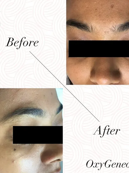 A before and after of an OxyGeneo facial, showing how it oxygenates and nourishes the skin to restore a healthy glow.