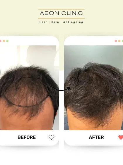 Here you can see the pre-operative markings for a hairline design and the impressive, natural-looking result achieved after the transplant.