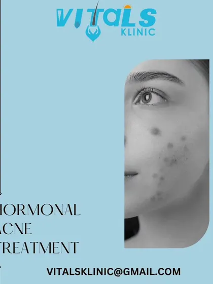 Hormonal acne requires a specific treatment plan that goes beyond topical creams. I offer various solutions, from medication to light therapy, to balance the skin and manage breakouts caused by hormonal fluctuations.