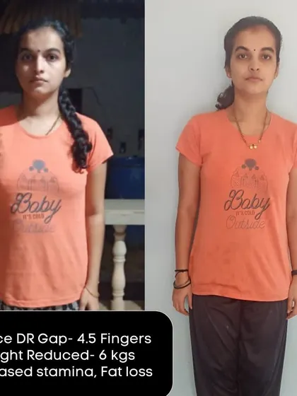 This collage of before and after photos celebrates the dedication of my clients. Each image tells a story of reduced DR gaps, weight loss, and newfound confidence.