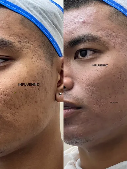 A clear demonstration of treating atrophic, or pitted, acne scars. The 'after' image shows a visible reduction in the depth and shadow of the scars.