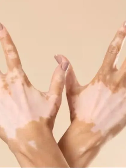 Vitiligo on the hands is common and can be challenging to treat. For stable vitiligo that doesn't respond to other treatments, I offer surgical options like punch grafting to transplant healthy pigment-producing cells and restore color.