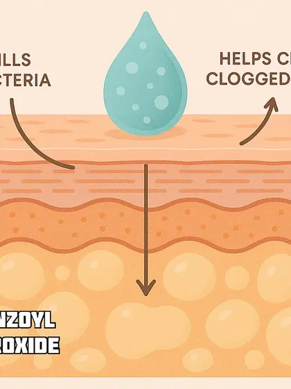 Benzoyl Peroxide is another effective ingredient for acne. This diagram shows how it works by killing bacteria and helping to clear clogged pores.
