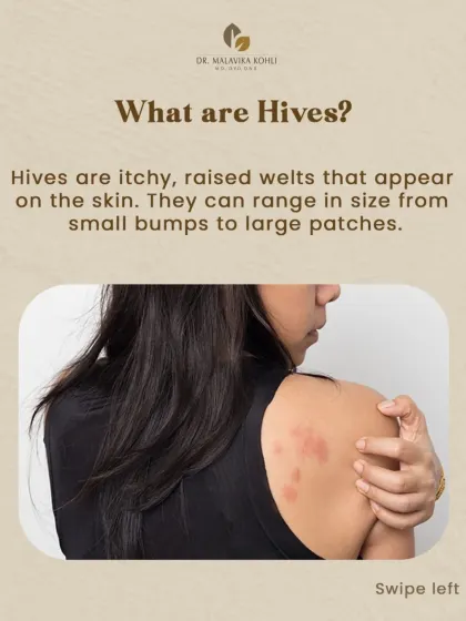 Hives, or urticaria, are itchy, raised welts that appear on the skin. They are a common skin reaction and can vary in size from small bumps to large, coalescing patches.