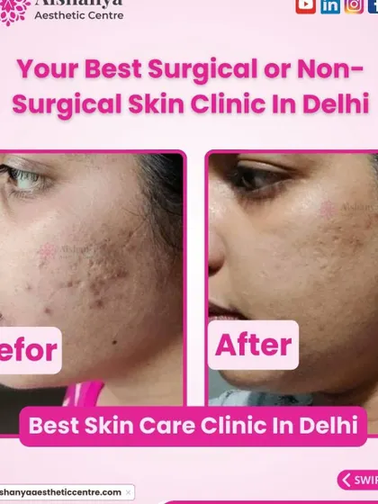 Here, you can see the successful treatment of deep, pitted acne scars. Using advanced procedures, we smoothed the skin's surface and stimulated collagen to fill in the indentations, resulting in a much more even texture.