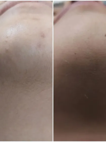 See the instant results of a dermaplaning facial. The 'after' image on the right shows a visible reduction in fine vellus hair and dead skin cells, resulting in a smoother, brighter complexion on the patient's chin and jawline.