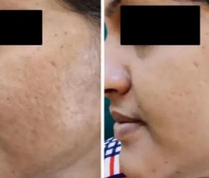 For patients with a combination of rolling scars and uneven texture, a tailored laser treatment plan is crucial. This result demonstrates how we can achieve a more uniform and smooth complexion by carefully targeting different types of scars.