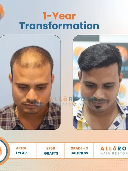 This one-year transformation for a Grade 3 baldness case was achieved with 2750 grafts. The series of photos demonstrates the significant improvement in density and hairline from every angle.