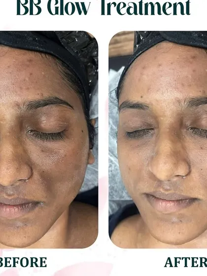 See the immediate transformation with our BB Glow treatment. This client wanted to address uneven skin tone and blemishes. The 'after' photo shows how the semi-permanent serum provides light coverage, reduces redness, and creates a flawless, dewy finish.