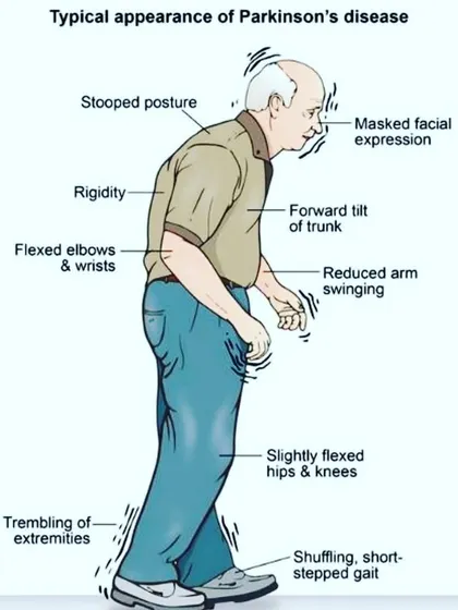 My therapeutic yoga practice offers specific support for neurological conditions like Parkinson's disease. This infographic shows the typical physical challenges, and my sessions focus on re-establishing the mind-body connection to improve posture, reduce rigidity, and enhance overall mobility.