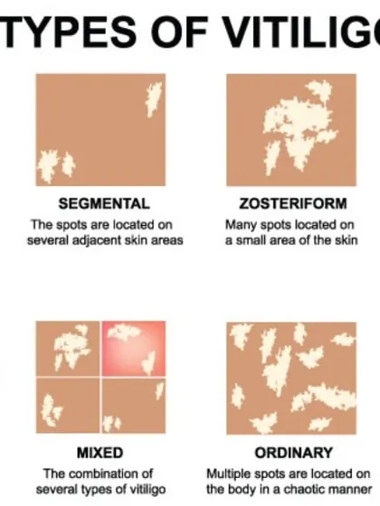 This graphic shows the different types of vitiligo, from focal to universal. A correct diagnosis of the type and stability of your vitiligo is crucial for me to design the most effective treatment plan for you.