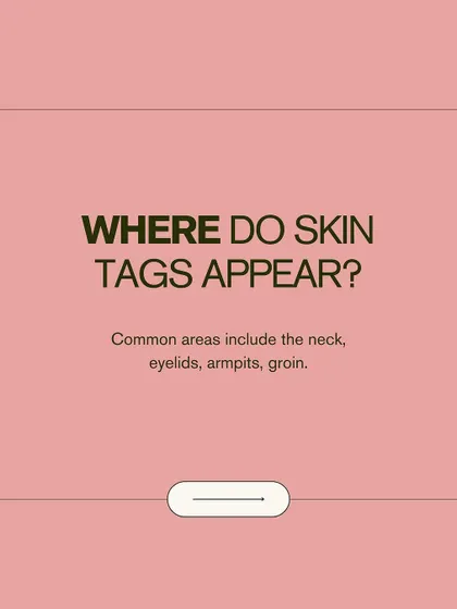 Where do skin tags commonly appear? They are often found on the neck, eyelids, armpits, and groin areas where skin rubs against skin or clothing.